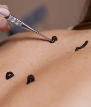 Leech Therapy