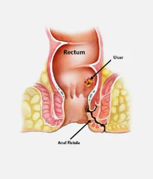 Piles Fissure & Fistula
