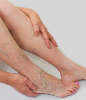 Varicose Vein Treatment