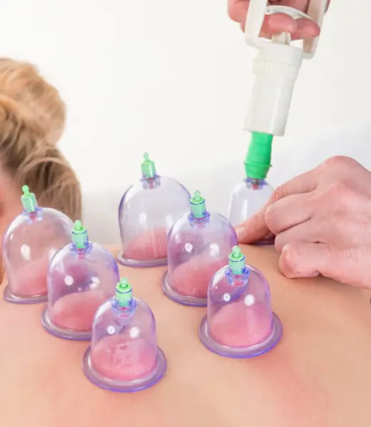 Cupping Therapy