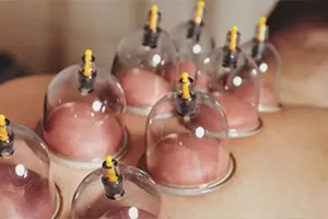 Cupping Therapist Course